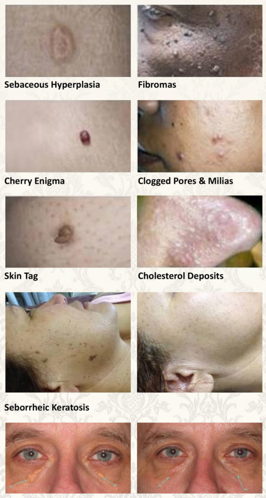 Lamprobe Lamprobe Non-surgical Blemish Removal | Desert Rose Health